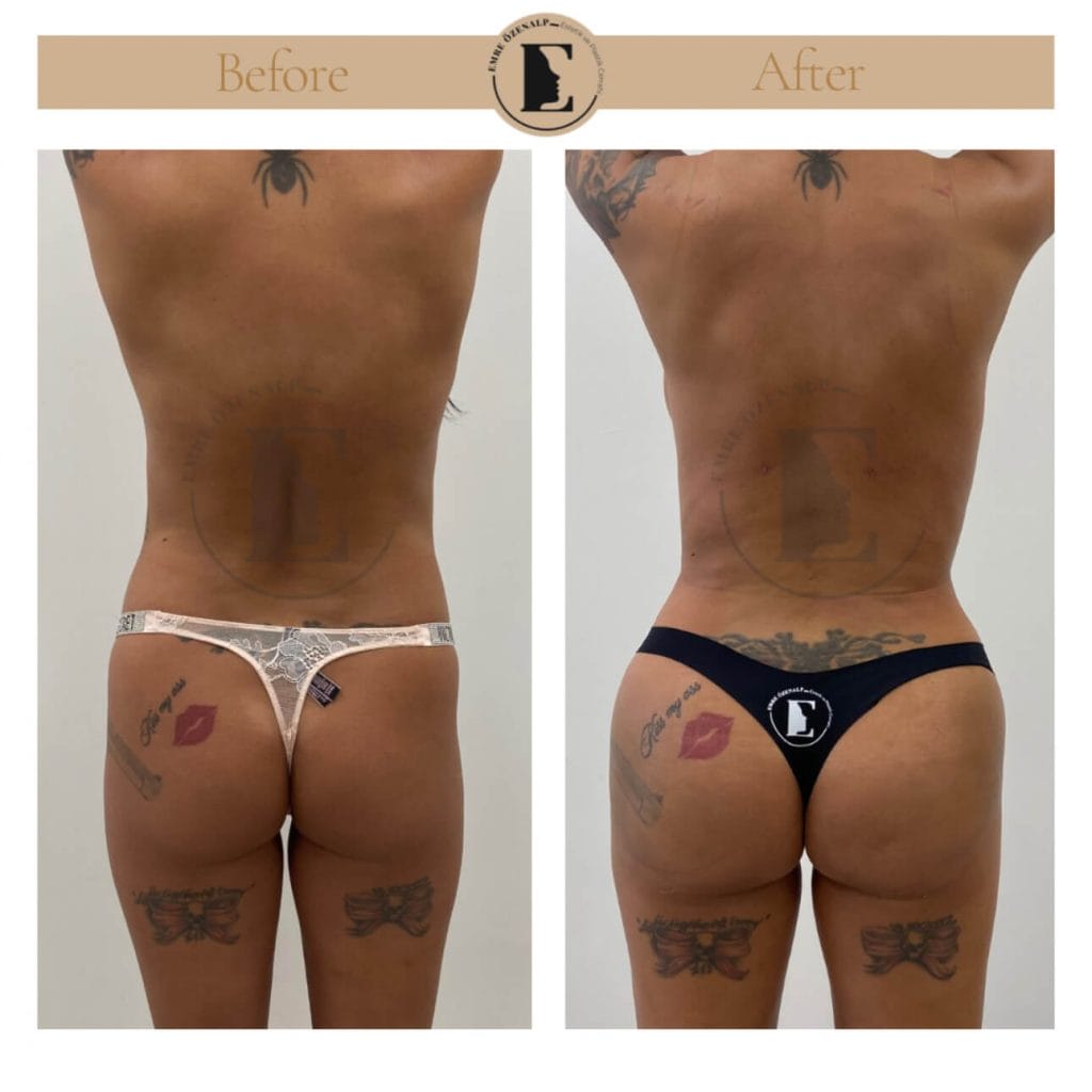 BBL (buttock augmentation) before after in Turkey results with experienced doctor Emre Özenalp. The patient has been done buttock augmentation with fat injection via vaser liposuction.