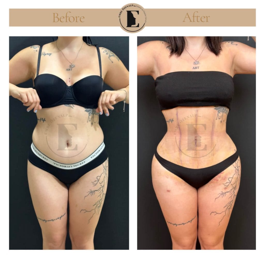 BBL (buttock augmentation) before after in Turkey results with experienced doctor Emre Özenalp. The patient has been done buttock augmentation with fat injection via vaser liposuction.