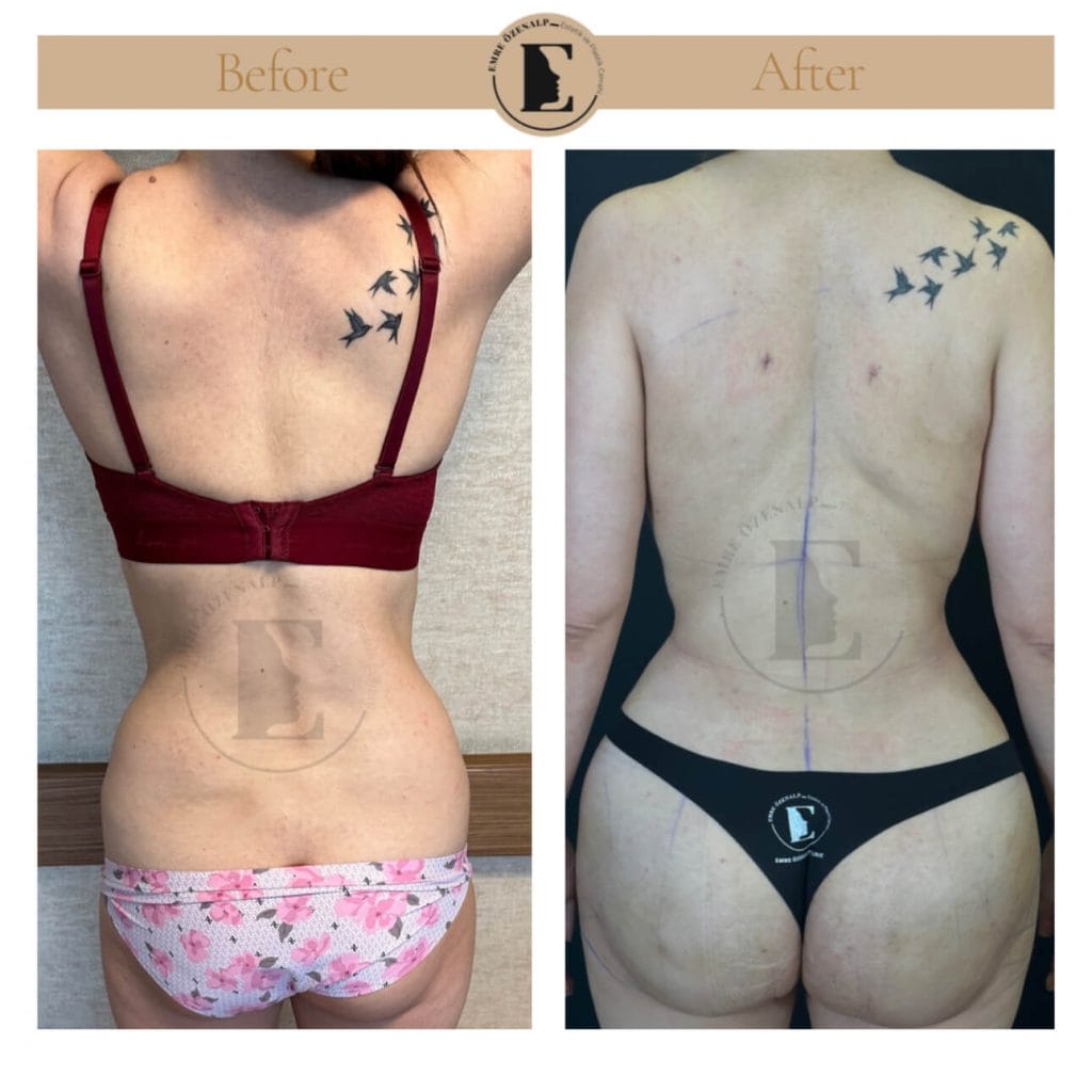 BBL (buttock augmentation) before after in Turkey results with experienced doctor Emre Özenalp. The patient has been done buttock augmentation with fat injection via vaser liposuction.