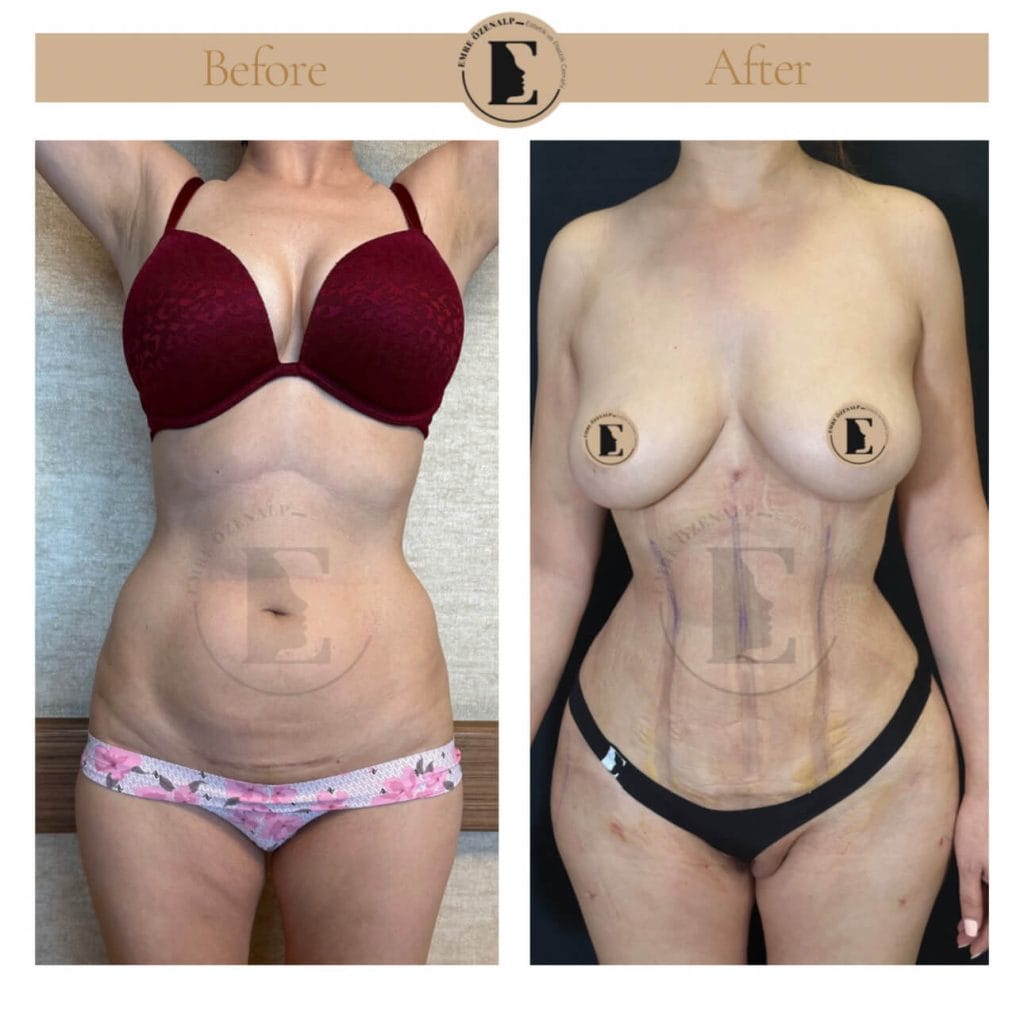 BBL (buttock augmentation) before after in Turkey results with experienced doctor Emre Özenalp. The patient has been done buttock augmentation with fat injection via vaser liposuction.