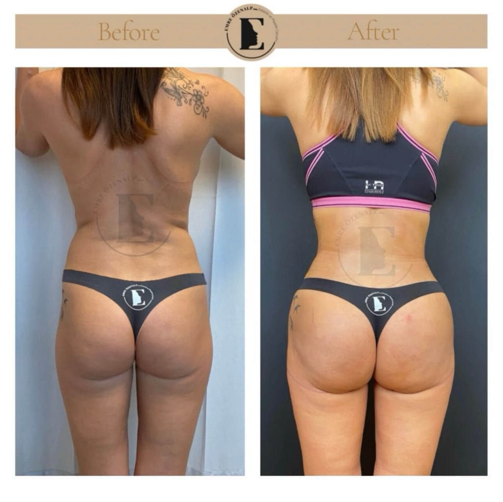BBL (buttock augmentation) before after in Turkey results with experienced doctor Emre Özenalp. The patient has been done buttock augmentation with fat injection via vaser liposuction.