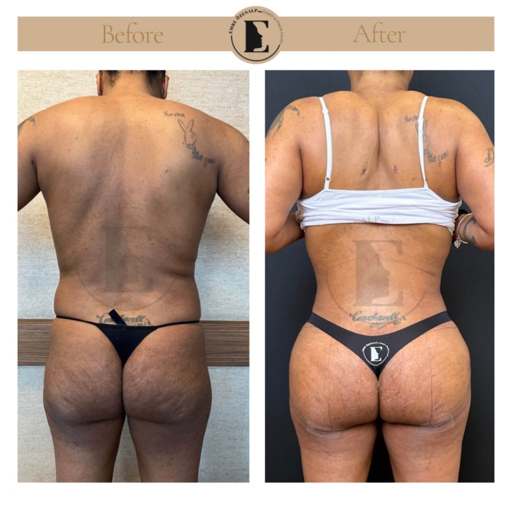BBL (buttock augmentation) before after in Turkey results with experienced doctor Emre Özenalp. The patient has been done buttock augmentation with fat injection via vaser liposuction.
