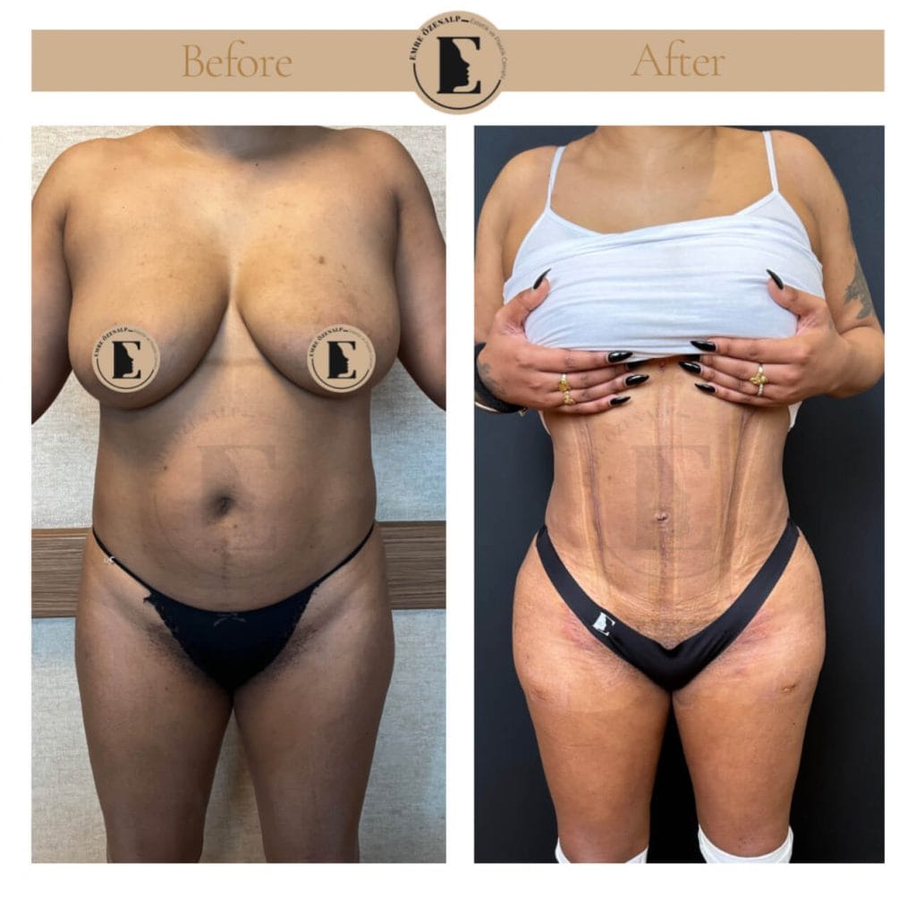 BBL (buttock augmentation) before after in Turkey results with experienced doctor Emre Özenalp. The patient has been done buttock augmentation with fat injection via vaser liposuction.