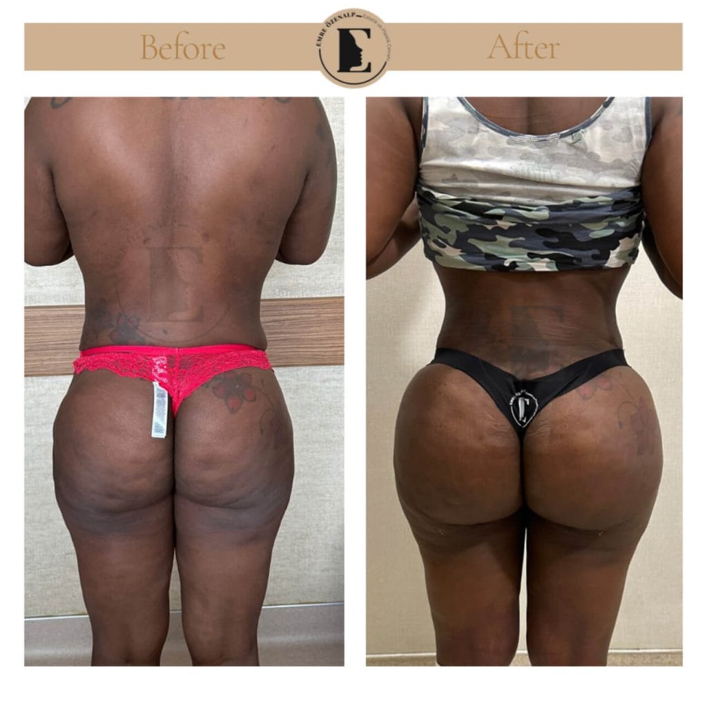 BBL (buttock augmentation) before after in Turkey results with experienced doctor Emre Özenalp. The patient has been done buttock augmentation with fat injection via vaser liposuction.