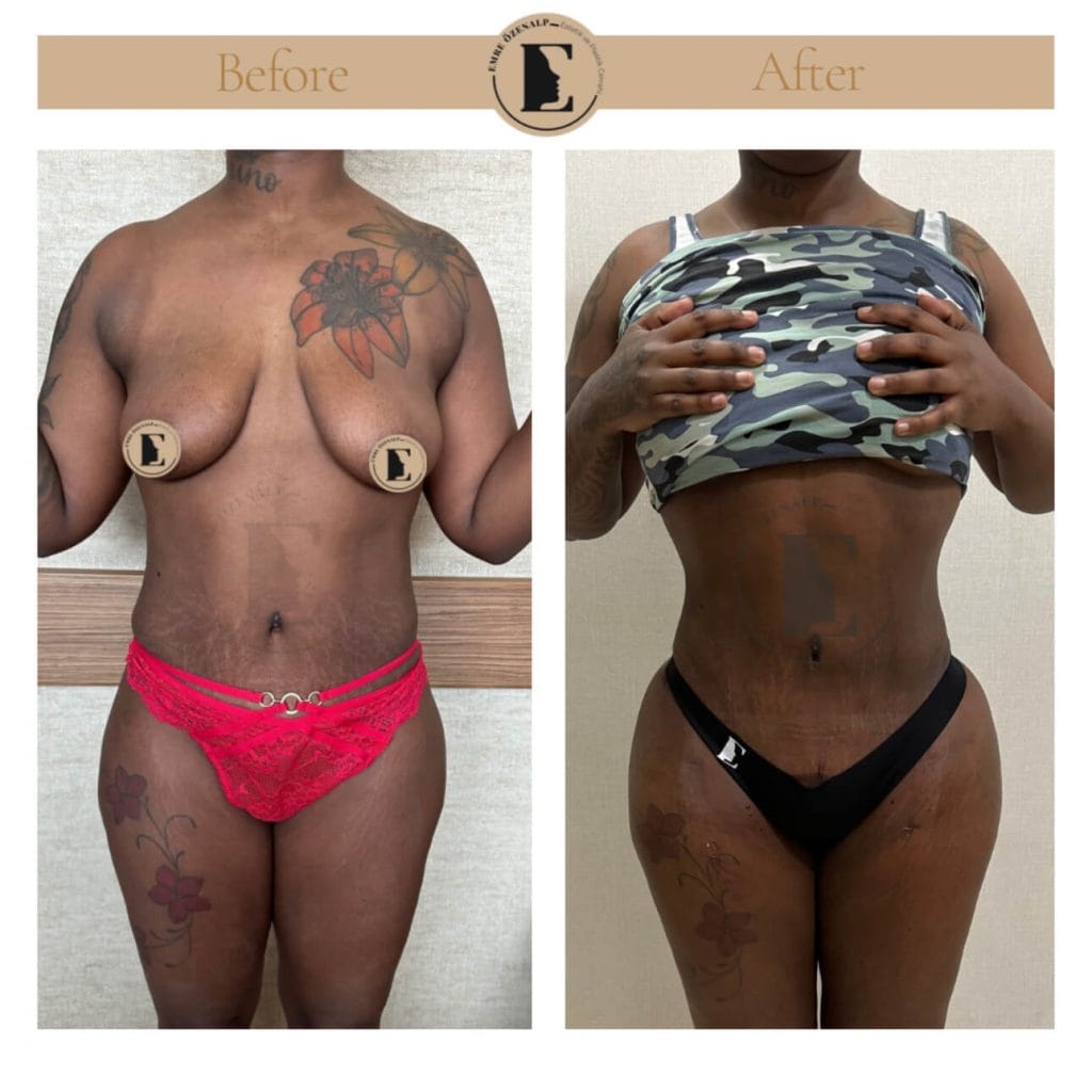 BBL (buttock augmentation) before after in Turkey results with experienced doctor Emre Özenalp. The patient has been done buttock augmentation with fat injection via vaser liposuction.