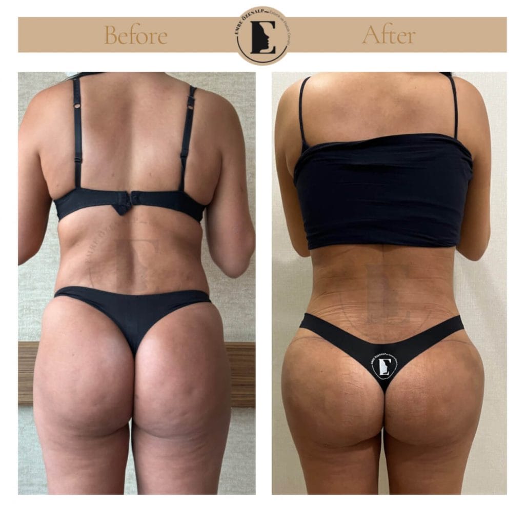 BBL (buttock augmentation) before after in Turkey results with experienced doctor Emre Özenalp. The patient has been done buttock augmentation with fat injection via vaser liposuction.