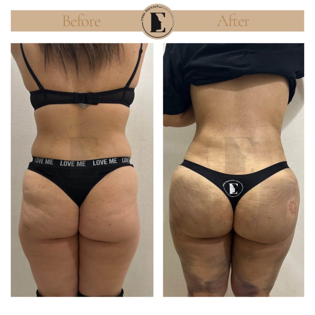 BBL (buttock augmentation) before after in Turkey results with experienced doctor Emre Özenalp. The patient has been done buttock augmentation with fat injection via vaser liposuction.