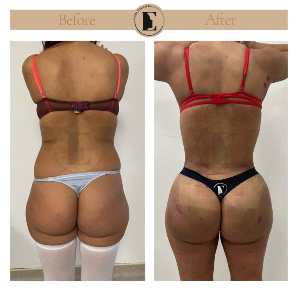 BBL (buttock augmentation) before after in Turkey results with experienced doctor Emre Özenalp. The patient has been done buttock augmentation with fat injection via vaser liposuction.