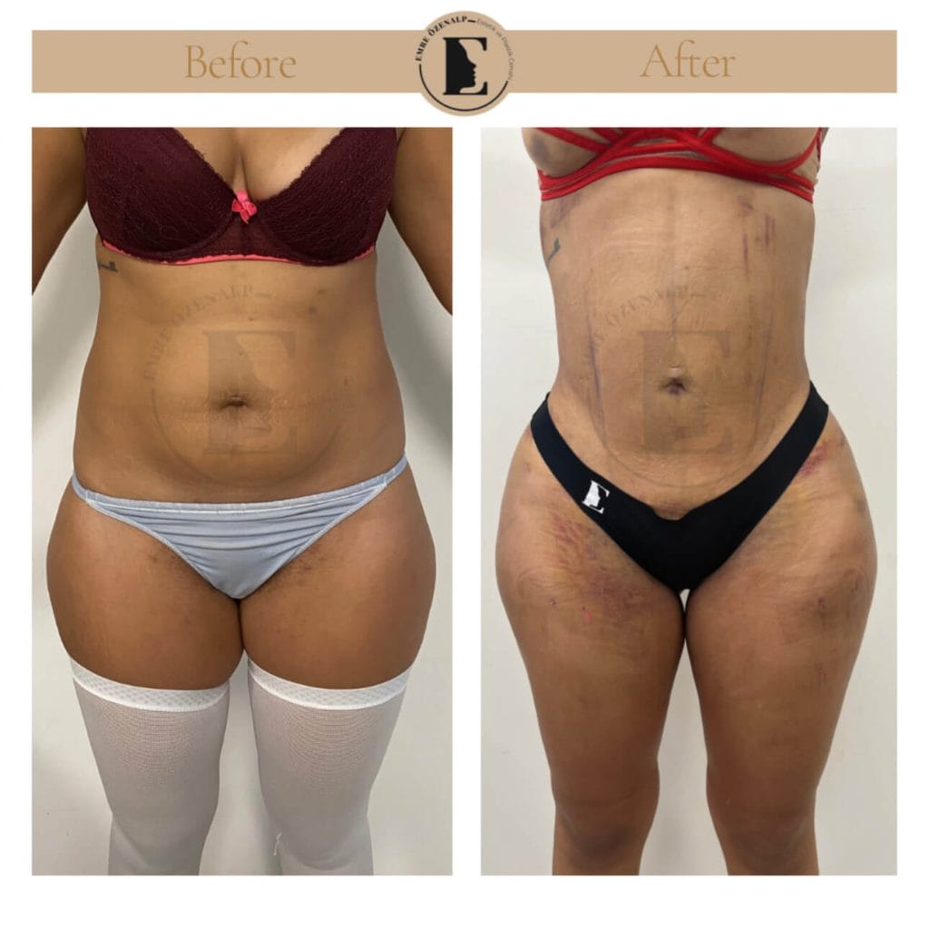 BBL (buttock augmentation) before after in Turkey results with experienced doctor Emre Özenalp. The patient has been done buttock augmentation with fat injection via vaser liposuction.