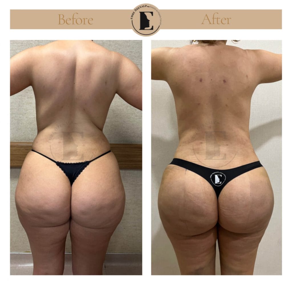 BBL (buttock augmentation) before after in Turkey results with experienced doctor Emre Özenalp. The patient has been done buttock augmentation with fat injection via vaser liposuction.