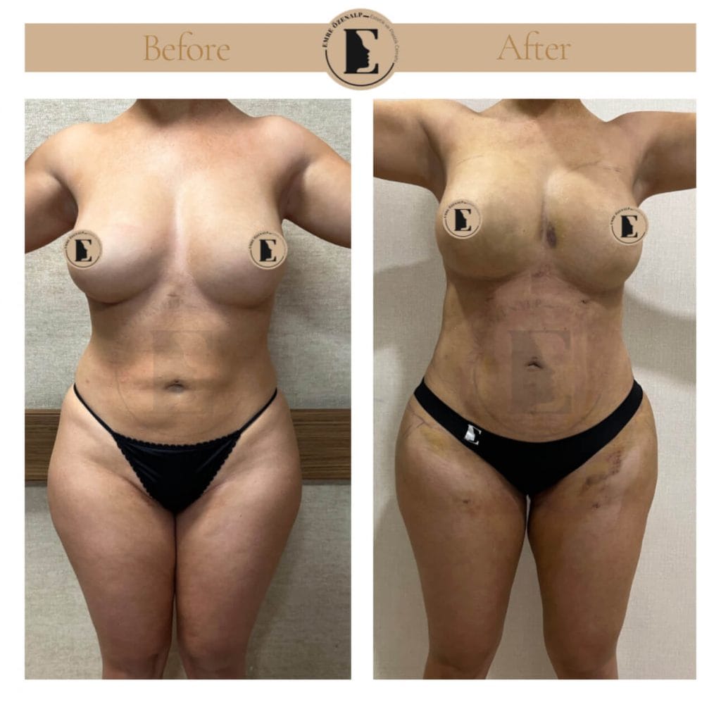 BBL (buttock augmentation) before after in Turkey results with experienced doctor Emre Özenalp. The patient has been done buttock augmentation with fat injection via vaser liposuction.