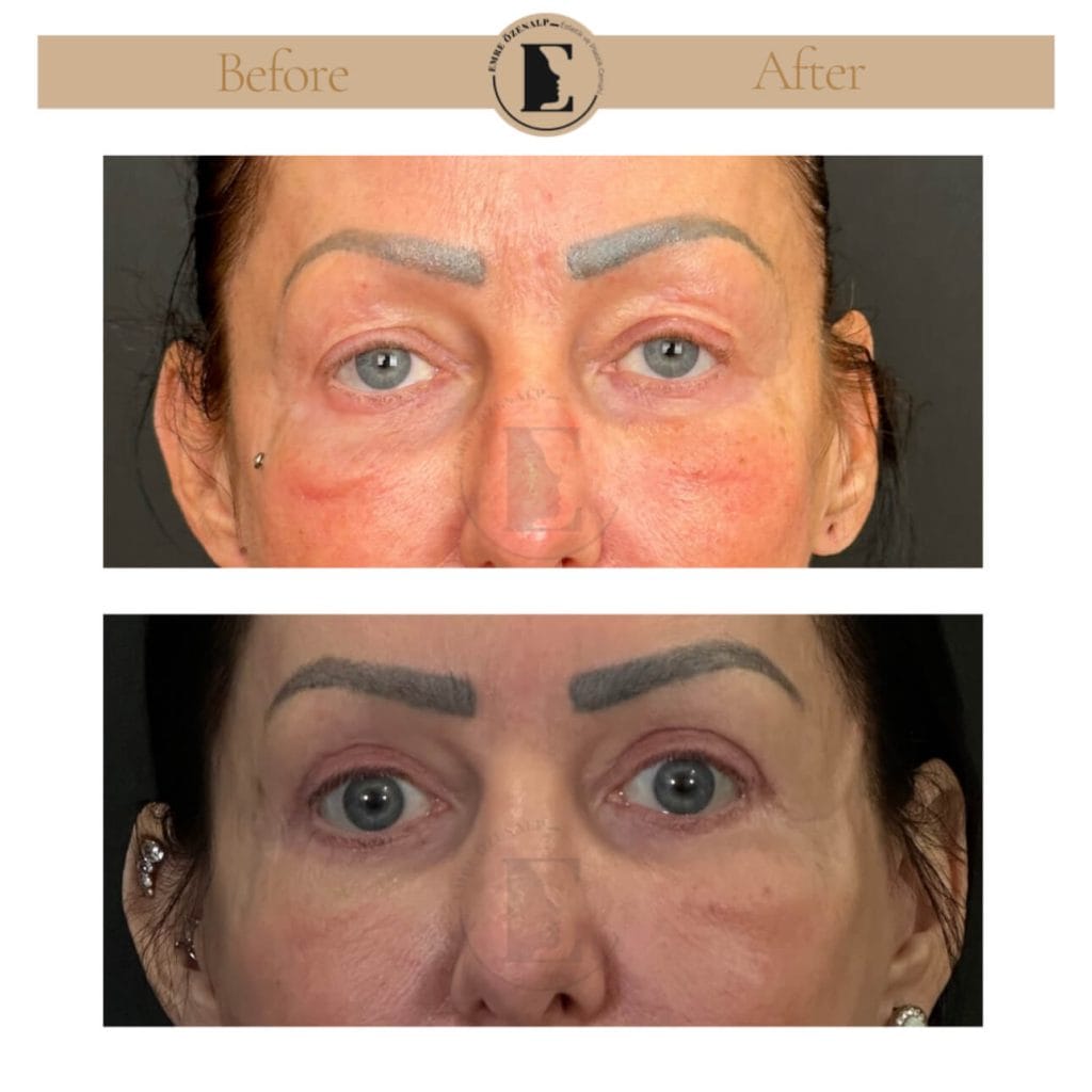 Eyelid surgery (blepharoplasty) before after in Turkey results with experienced doctor Emre Özenalp. The patient has been done eyelid surgery.