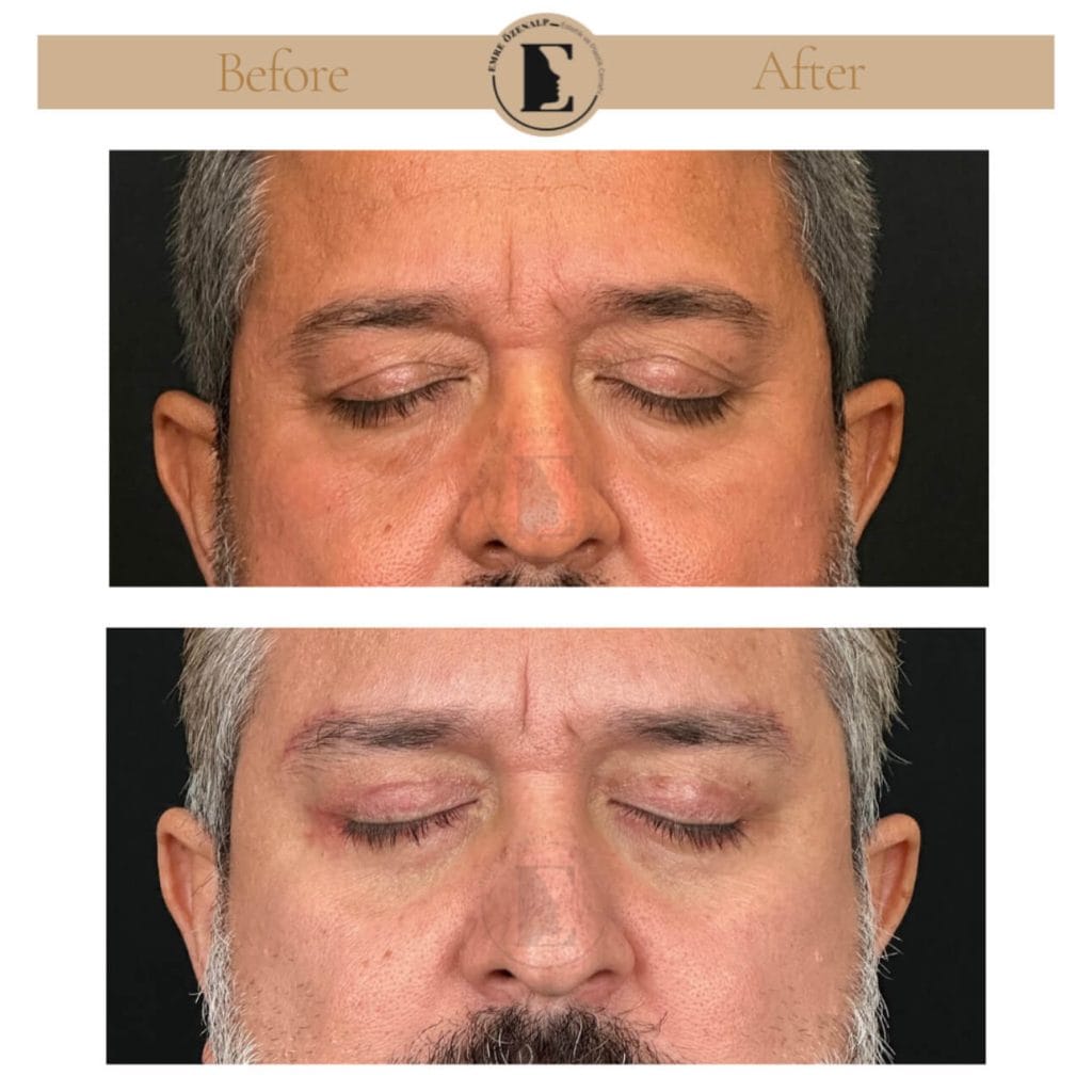 Eyelid surgery (blepharoplasty) before after in Turkey results with experienced doctor Emre Özenalp. The patient has been done eyelid surgery.