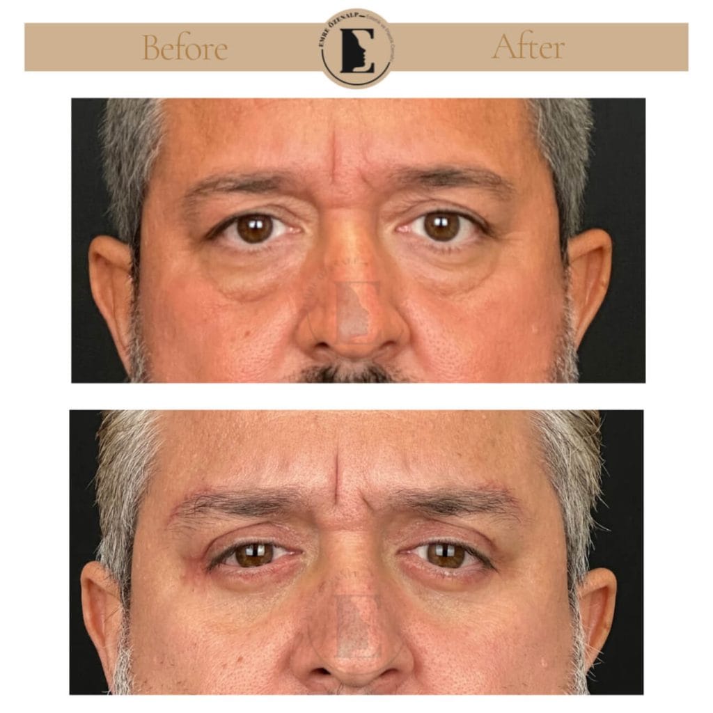 Eyelid surgery (blepharoplasty) before after in Turkey results with experienced doctor Emre Özenalp. The patient has been done eyelid surgery.