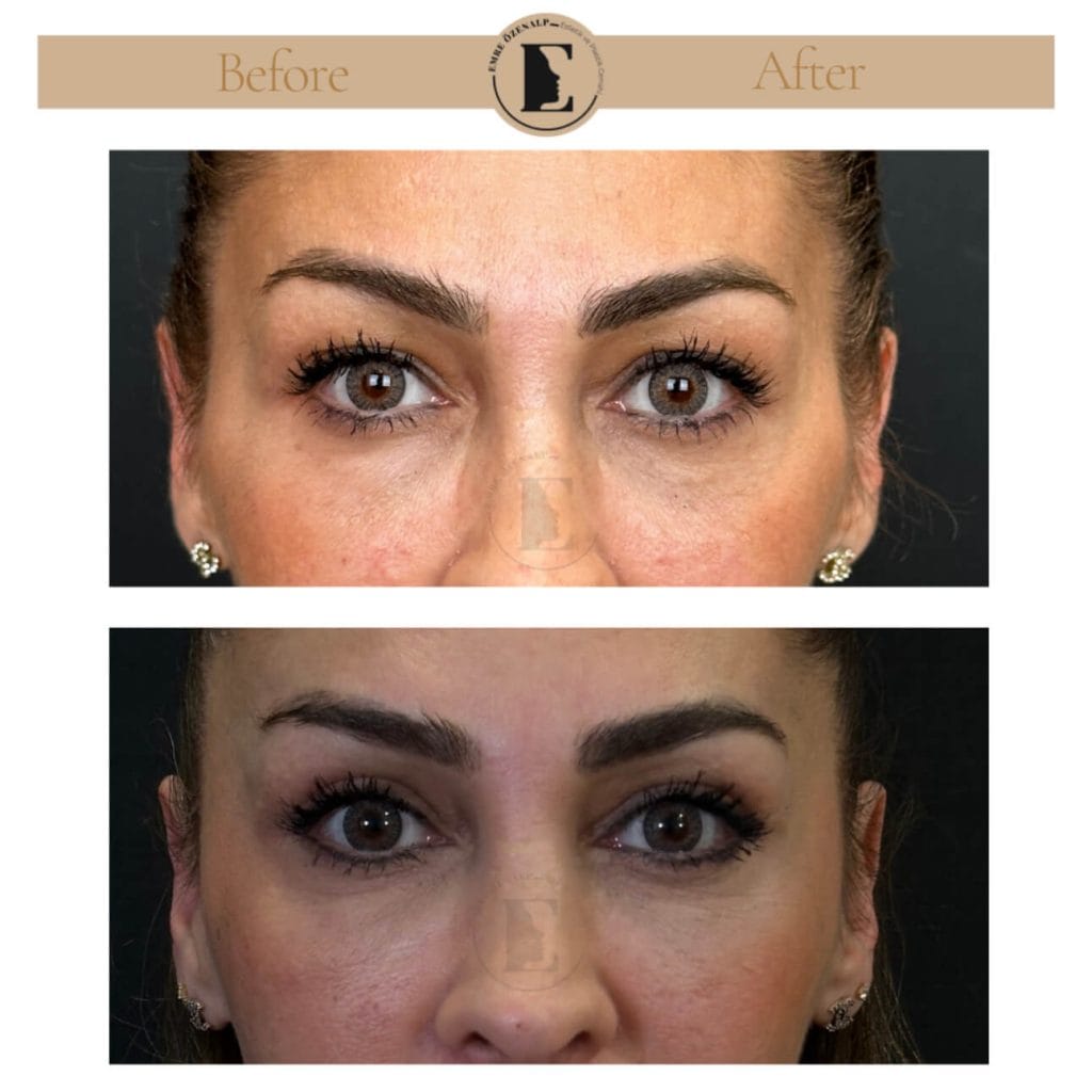 Eyelid surgery (blepharoplasty) before after in Turkey results with experienced doctor Emre Özenalp. The patient has been done eyelid surgery.