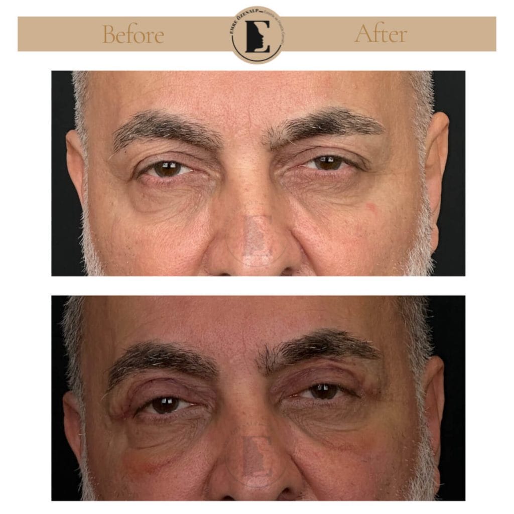 Eyelid surgery (blepharoplasty) before after in Turkey results with experienced doctor Emre Özenalp. The patient has been done eyelid surgery.