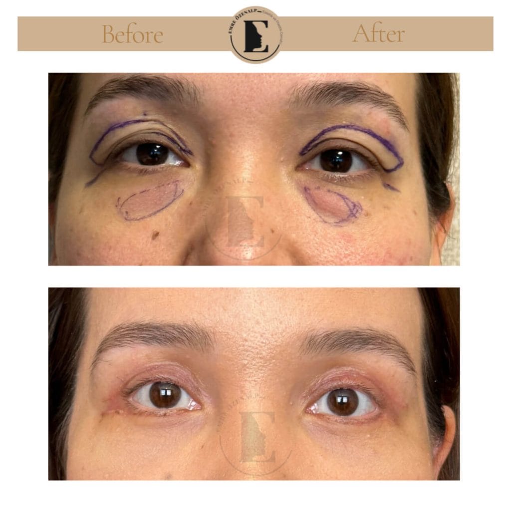 Eyelid surgery (blepharoplasty) before after in Turkey results with experienced doctor Emre Özenalp. The patient has been done eyelid surgery.