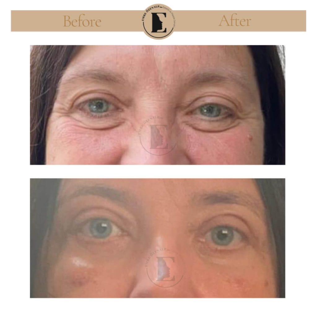 Eyelid surgery (blepharoplasty) before after in Turkey results with experienced doctor Emre Özenalp. The patient has been done eyelid surgery.