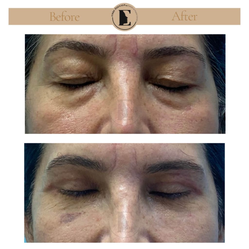Eyelid surgery (blepharoplasty) before after in Turkey results with experienced doctor Emre Özenalp. The patient has been done eyelid surgery.
