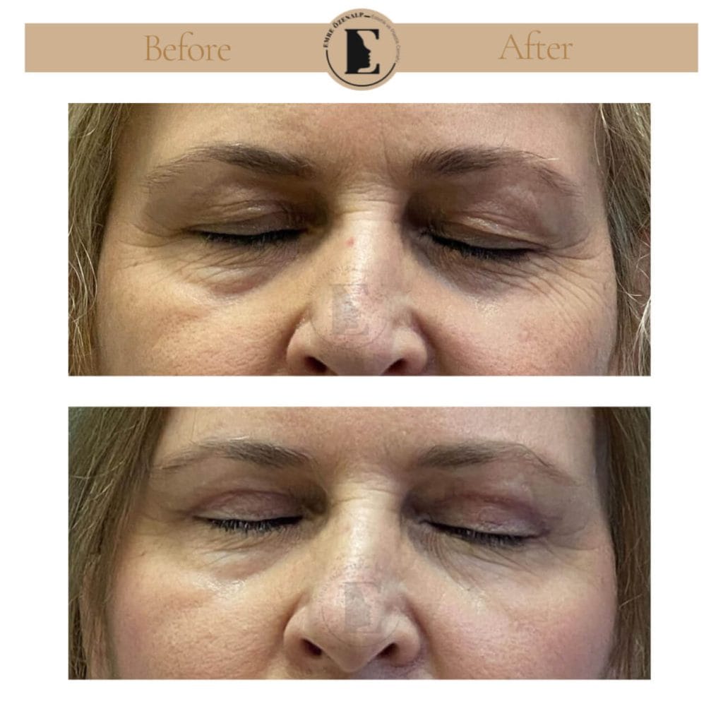 Eyelid surgery (blepharoplasty) before after in Turkey results with experienced doctor Emre Özenalp. The patient has been done eyelid surgery.