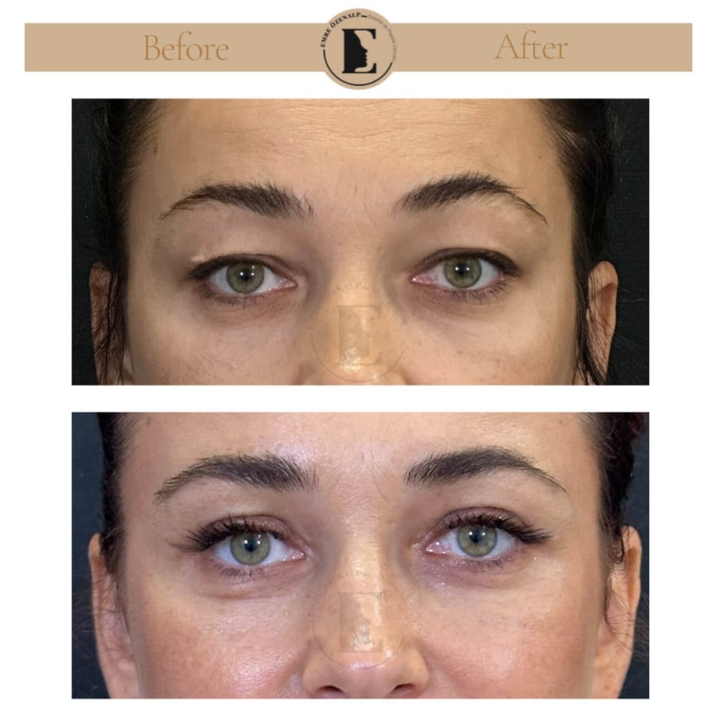 Eyelid surgery (blepharoplasty) before after in Turkey results with experienced doctor Emre Özenalp. The patient has been done eyelid surgery.