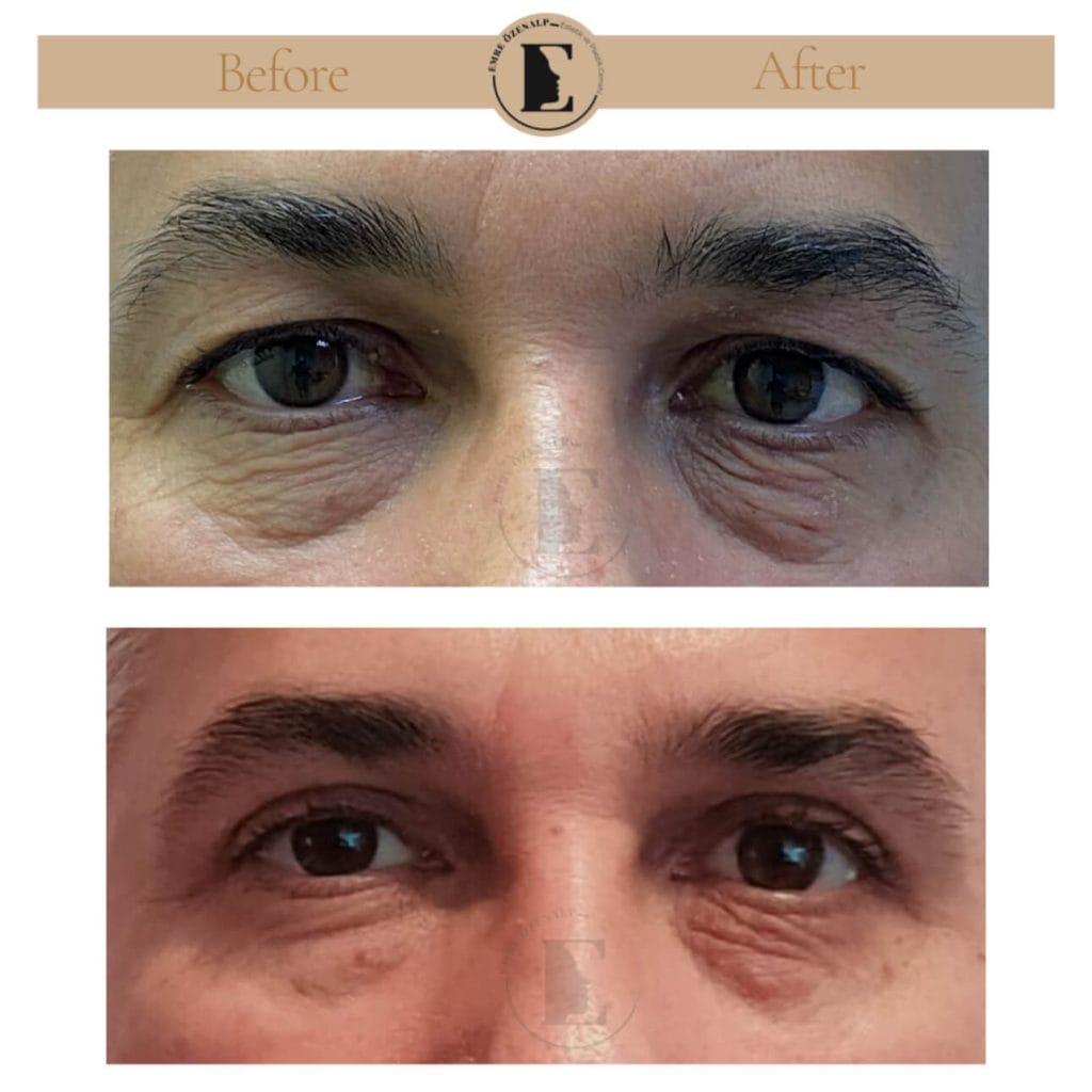 Eyelid surgery (blepharoplasty) before after in Turkey results with experienced doctor Emre Özenalp. The patient has been done eyelid surgery.