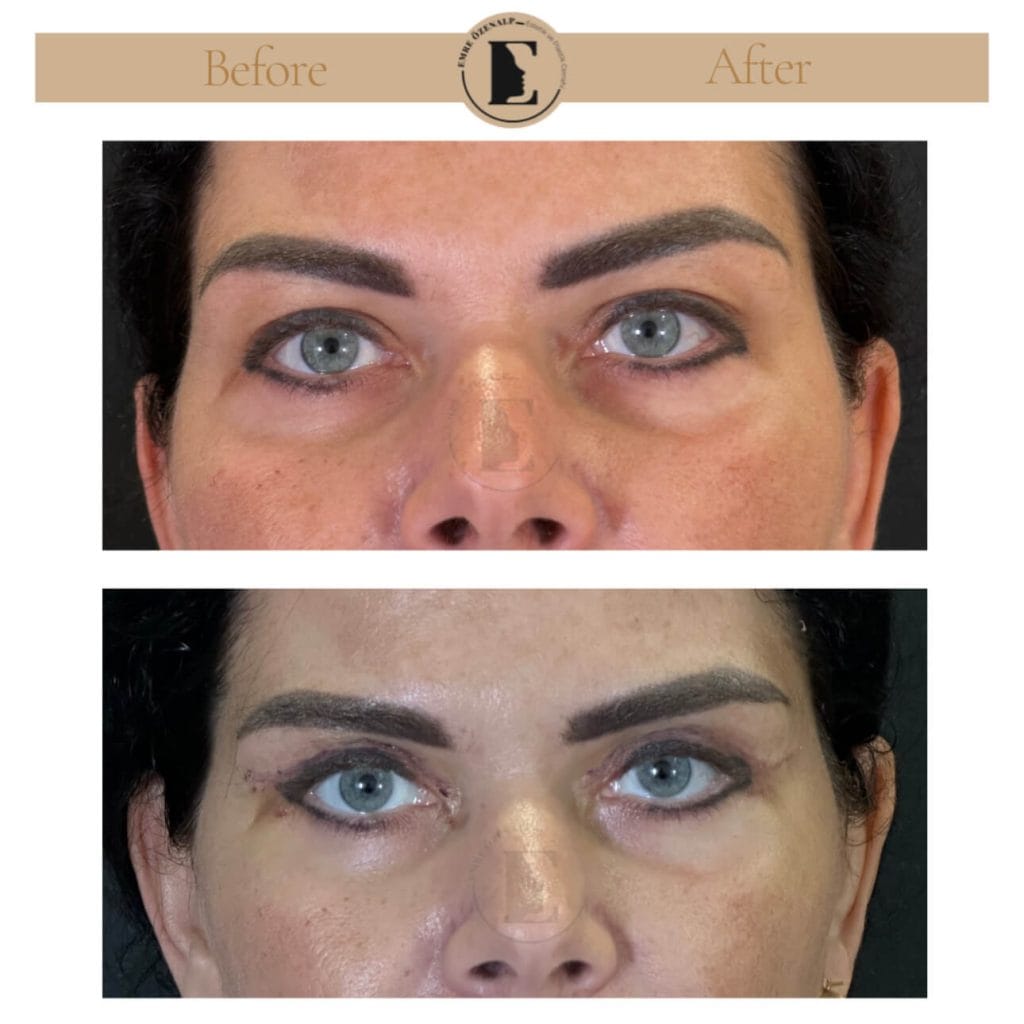 Eyelid surgery (blepharoplasty) before after in Turkey results with experienced doctor Emre Özenalp. The patient has been done eyelid surgery.