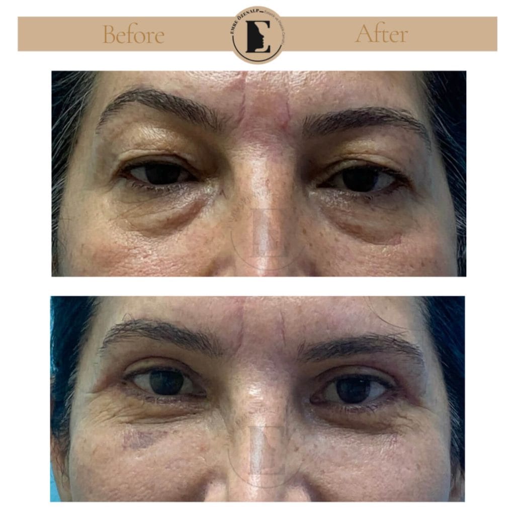 Eyelid surgery (blepharoplasty) before after in Turkey results with experienced doctor Emre Özenalp. The patient has been done eyelid surgery.