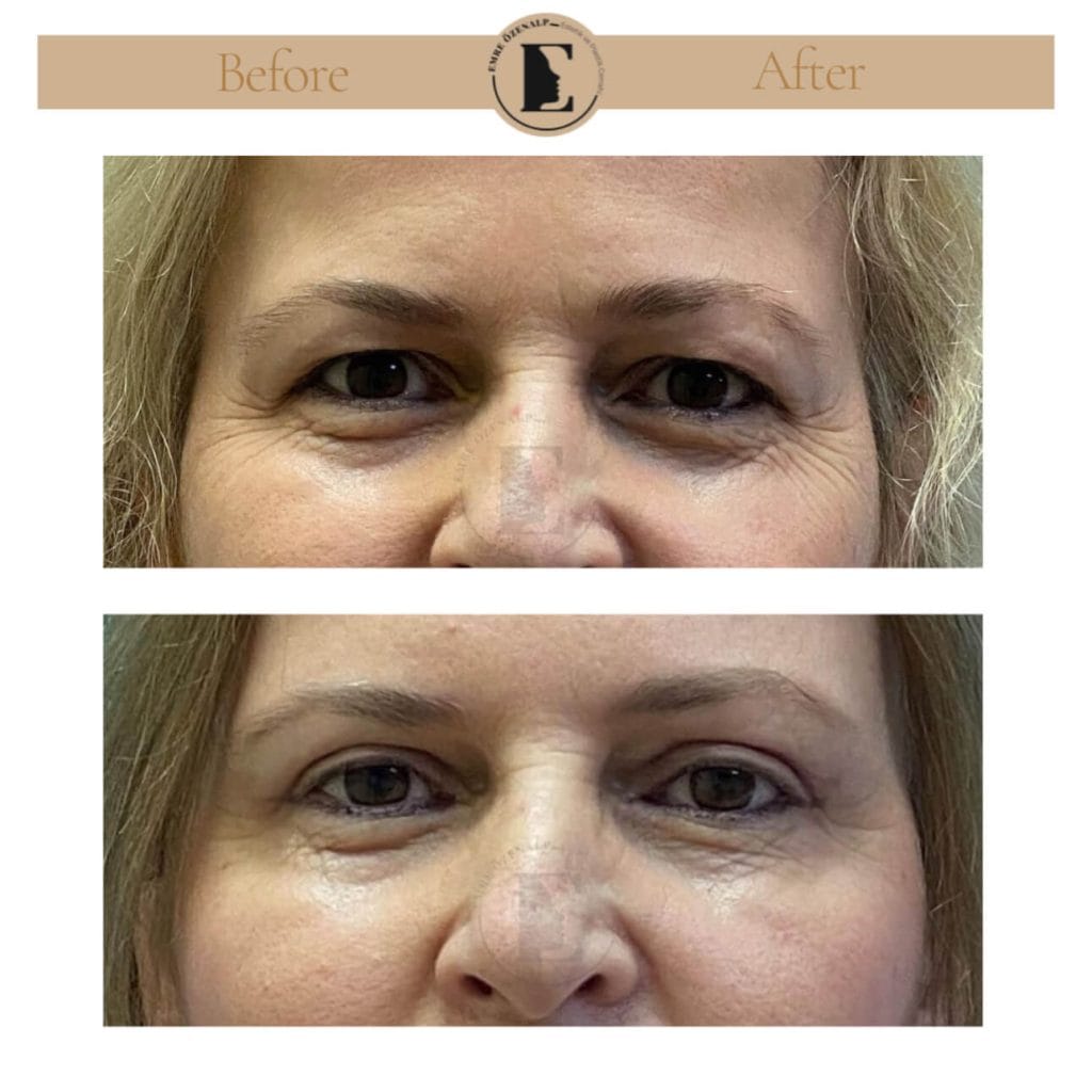 Eyelid surgery (blepharoplasty) before after in Turkey results with experienced doctor Emre Özenalp. The patient has been done eyelid surgery.