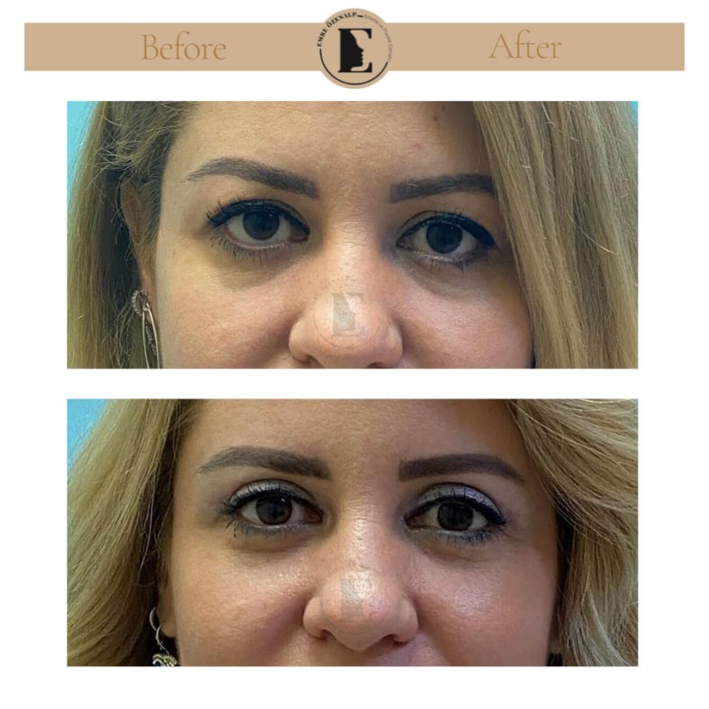 Eyelid surgery (blepharoplasty) before after in Turkey results with experienced doctor Emre Özenalp. The patient has been done eyelid surgery.