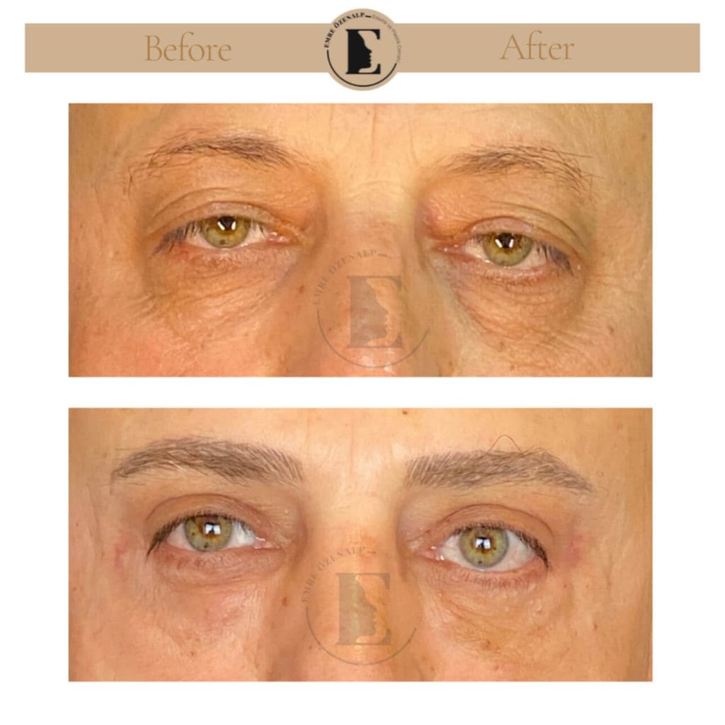 Eyelid surgery (blepharoplasty) before after in Turkey results with experienced doctor Emre Özenalp. The patient has been done eyelid surgery.