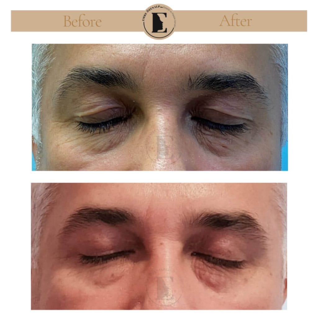 Eyelid surgery (blepharoplasty) before after in Turkey results with experienced doctor Emre Özenalp. The patient has been done eyelid surgery.