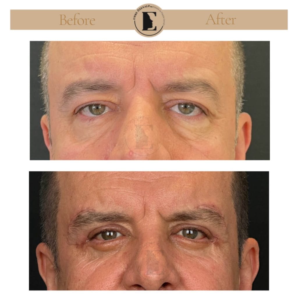 Eyelid surgery (blepharoplasty) before after in Turkey results with experienced doctor Emre Özenalp. The patient has been done eyelid surgery.