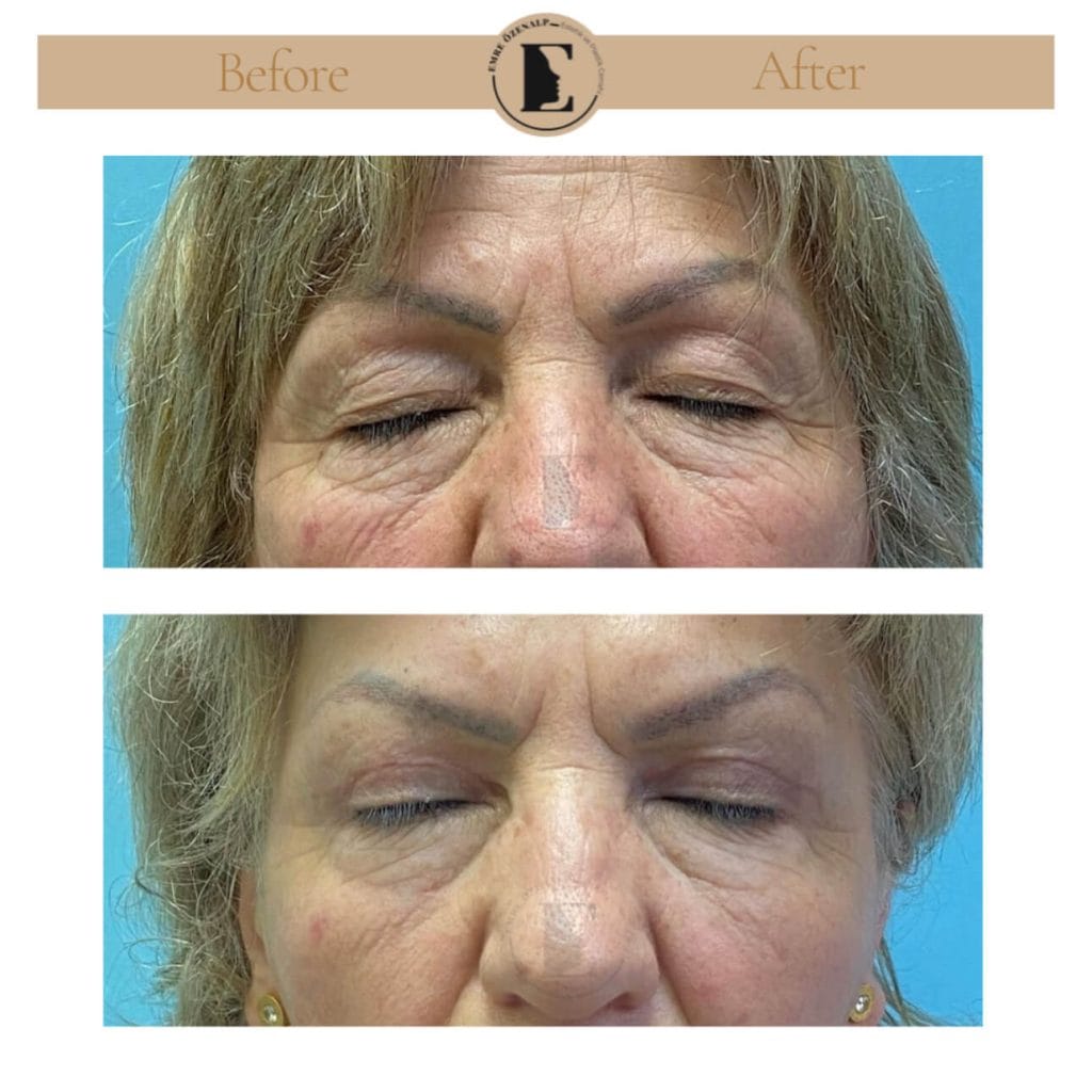 Eyelid surgery (blepharoplasty) before after in Turkey results with experienced doctor Emre Özenalp. The patient has been done eyelid surgery.