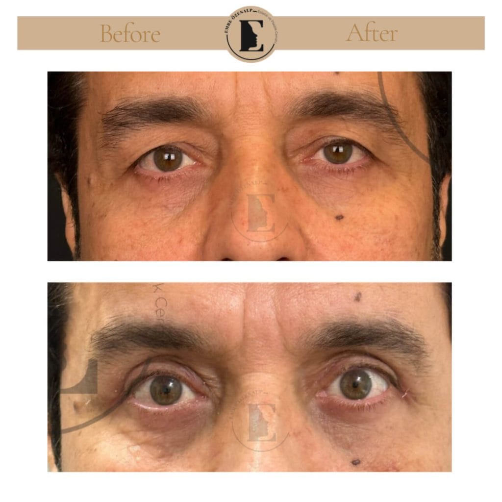 Eyelid surgery (blepharoplasty) before after in Turkey results with experienced doctor Emre Özenalp. The patient has been done eyelid surgery.