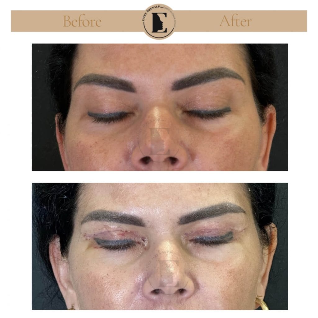 Eyelid surgery (blepharoplasty) before after in Turkey results with experienced doctor Emre Özenalp. The patient has been done eyelid surgery.