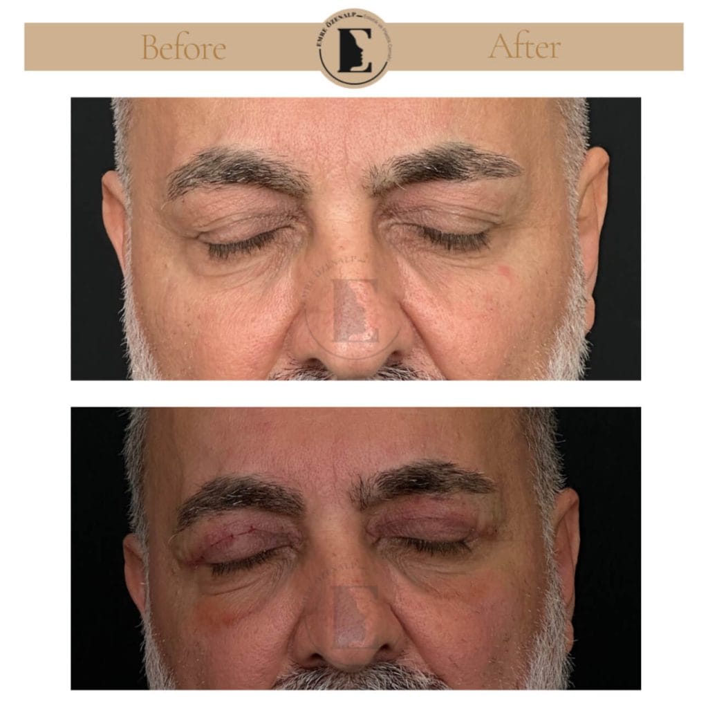 Eyelid surgery (blepharoplasty) before after in Turkey results with experienced doctor Emre Özenalp. The patient has been done eyelid surgery.