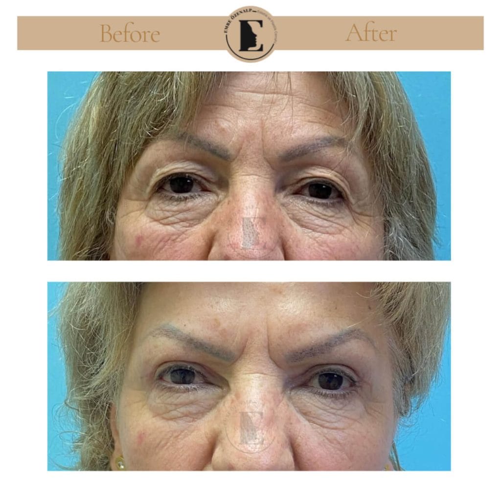 Eyelid surgery (blepharoplasty) before after in Turkey results with experienced doctor Emre Özenalp. The patient has been done eyelid surgery.
