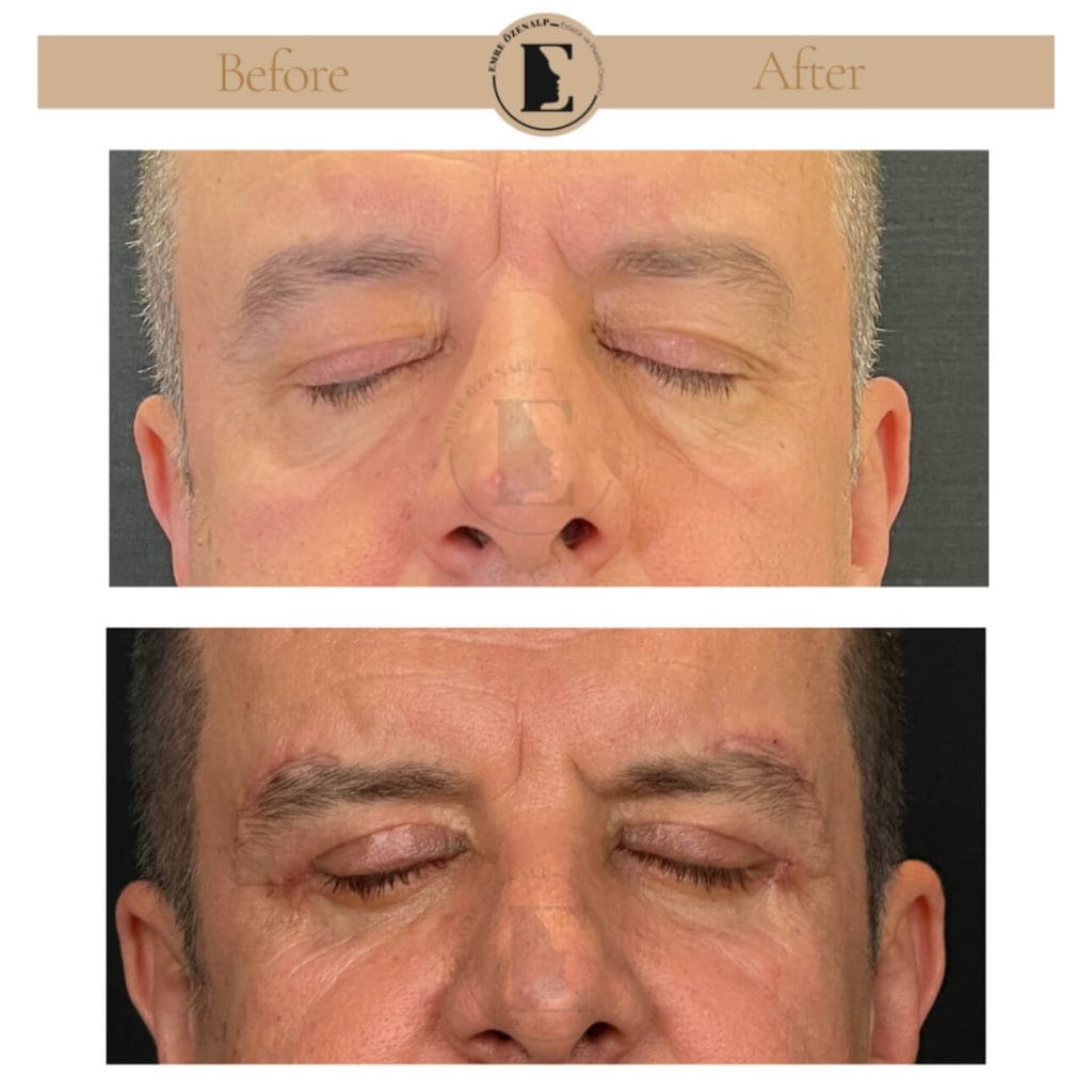 Eyelid surgery (blepharoplasty) before after in Turkey results with experienced doctor Emre Özenalp. The patient has been done eyelid surgery.