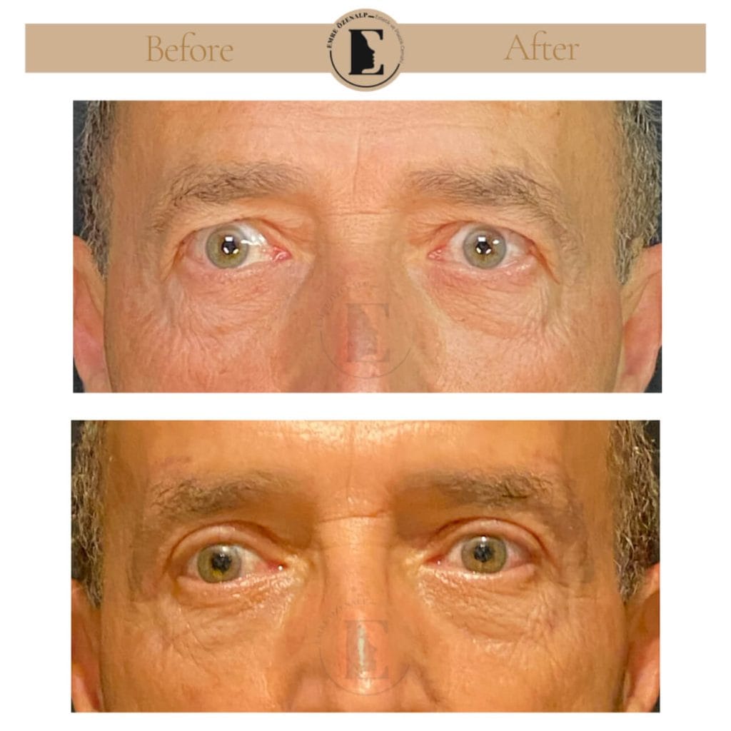 Eyelid surgery (blepharoplasty) before after in Turkey results with experienced doctor Emre Özenalp. The patient has been done eyelid surgery.