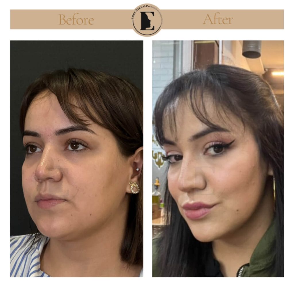 Buccal fat removal before after in Turkey results with experienced doctor Emre Özenalp. The patient has been done bichectomy surgery.