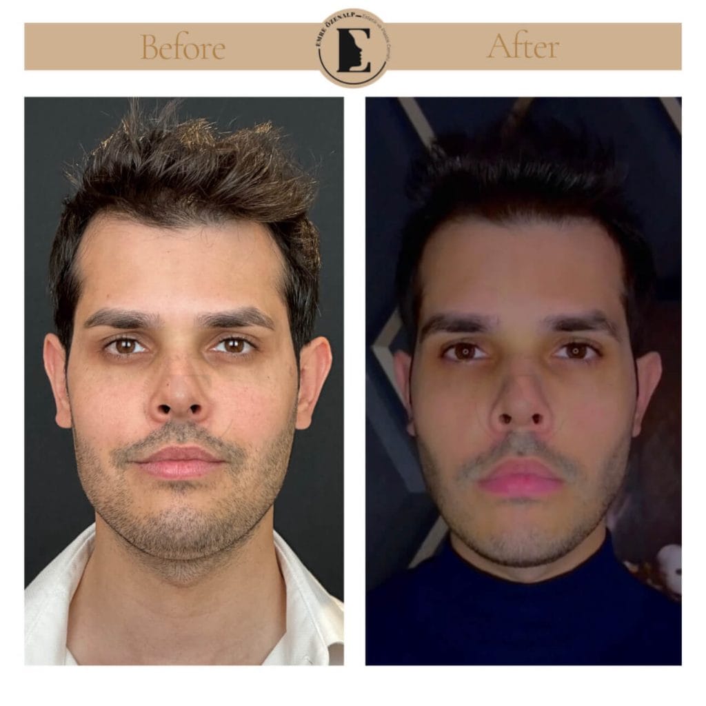 Buccal fat removal before after in Turkey results with experienced doctor Emre Özenalp. The patient has been done bichectomy surgery.