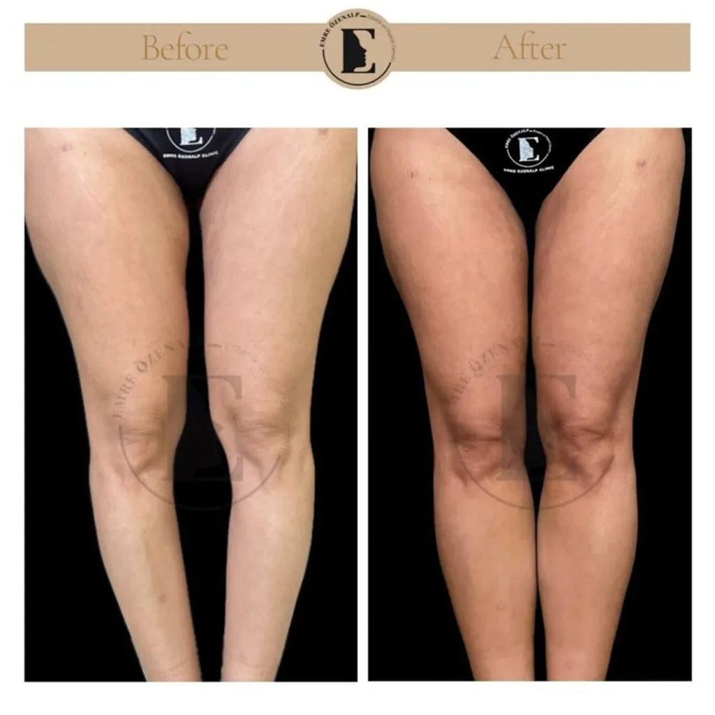 Calf implant before after in Turkey results with experienced doctor Emre Özenalp. The patient has been done calf augmentation with silicone implant.