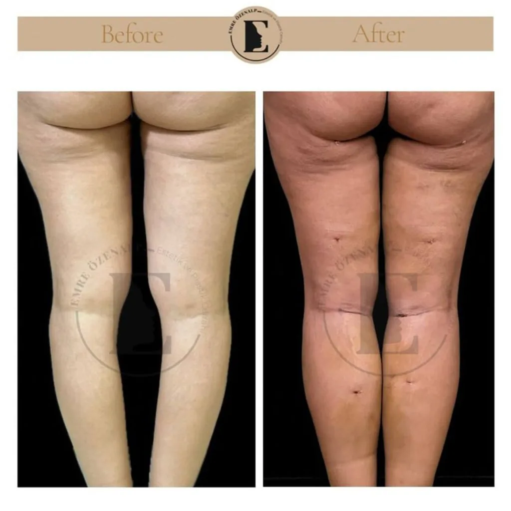 Calf implant before after in Turkey results with experienced doctor Emre Özenalp. The patient has been done calf augmentation with silicone implant.