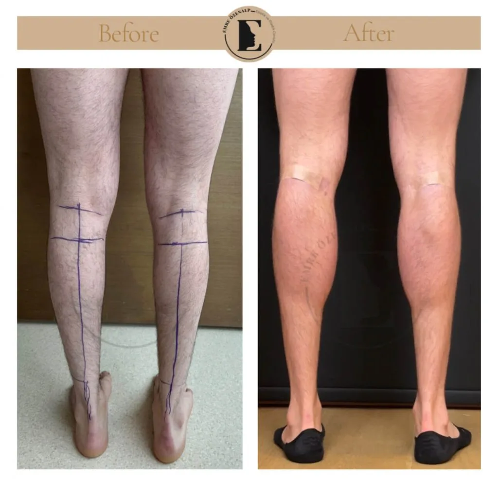 Calf implant before after in Turkey results with experienced doctor Emre Özenalp. The patient has been done calf augmentation with silicone implant.