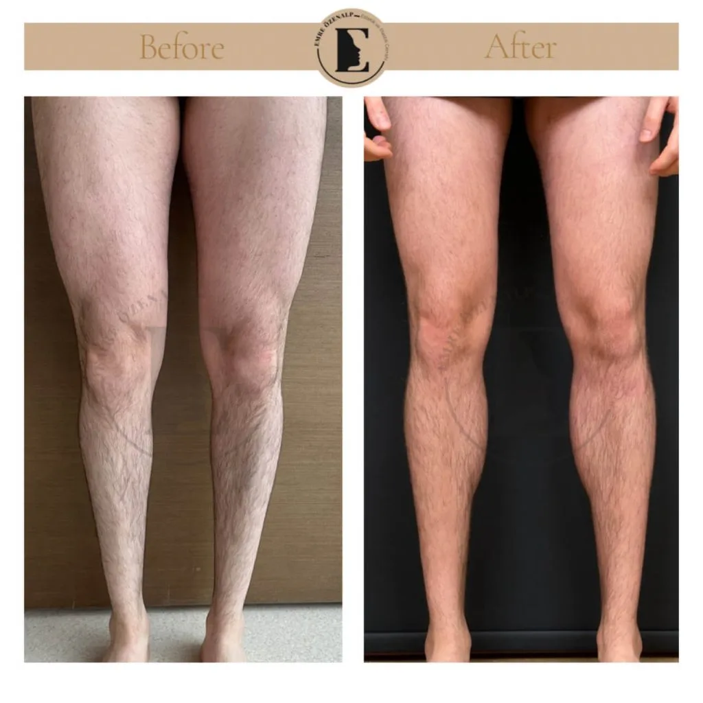 Calf implant before after in Turkey results with experienced doctor Emre Özenalp. The patient has been done calf augmentation with silicone implant.