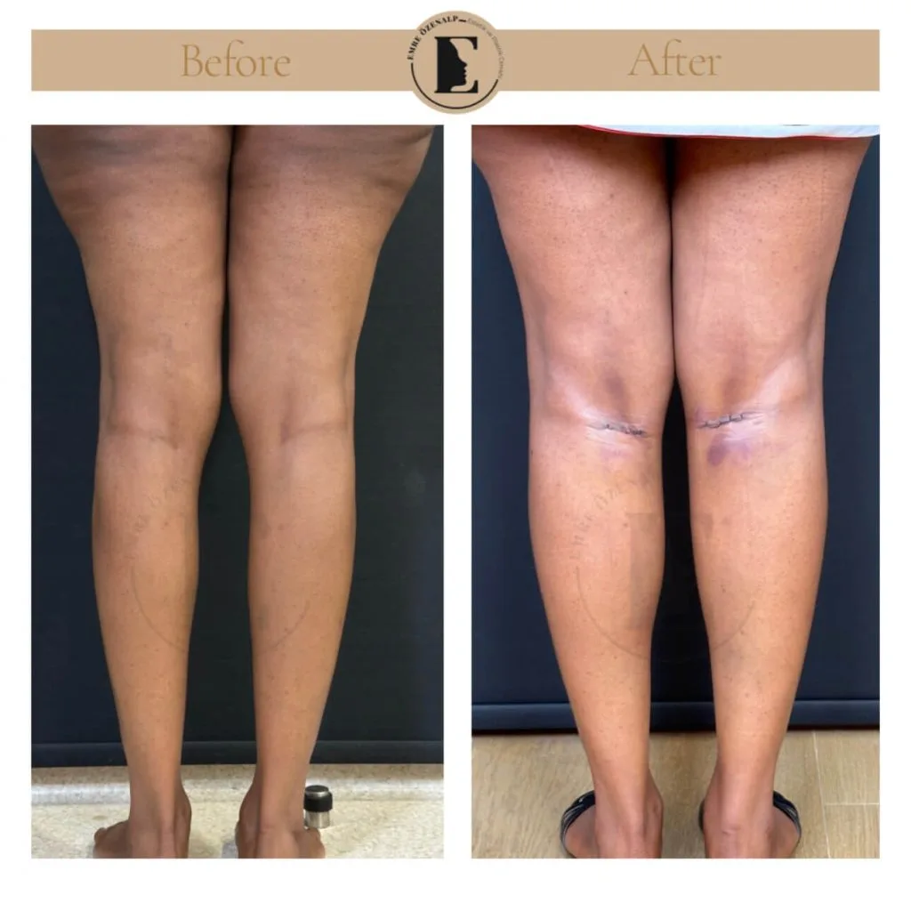 Calf implant before after in Turkey results with experienced doctor Emre Özenalp. The patient has been done calf augmentation with silicone implant.