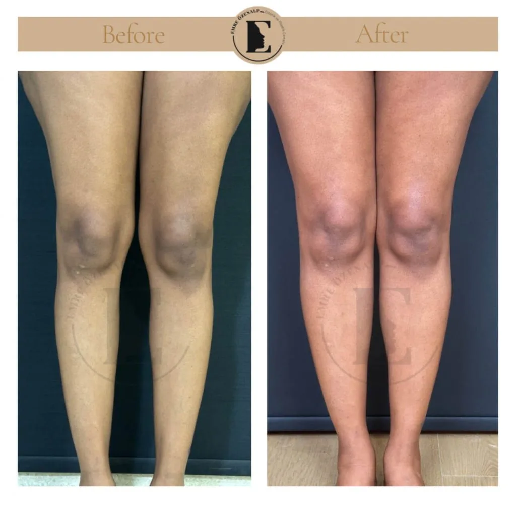 Calf implant before after in Turkey results with experienced doctor Emre Özenalp. The patient has been done calf augmentation with silicone implant.