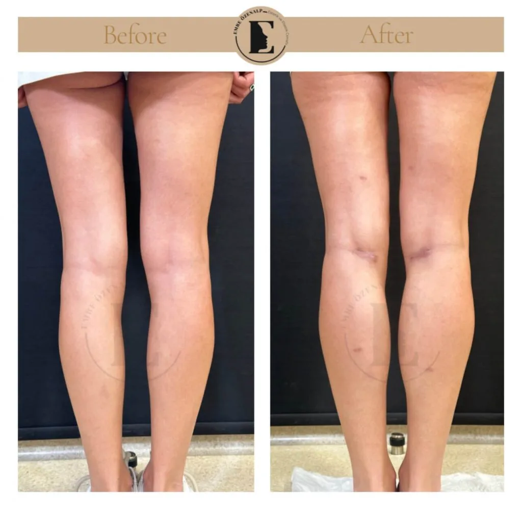 Calf implant before after in Turkey results with experienced doctor Emre Özenalp. The patient has been done calf augmentation with silicone implant.