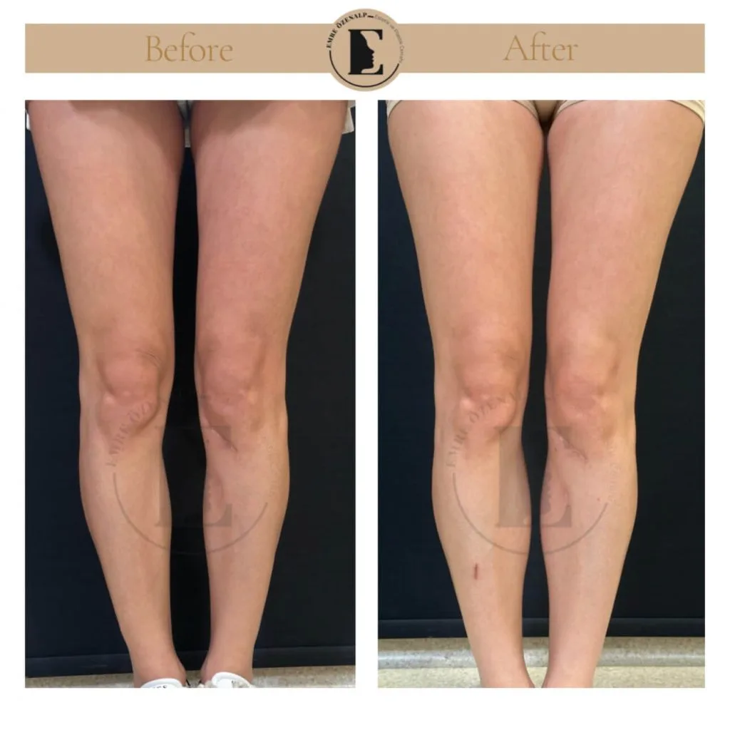 Calf implant before after in Turkey results with experienced doctor Emre Özenalp. The patient has been done calf augmentation with silicone implant.